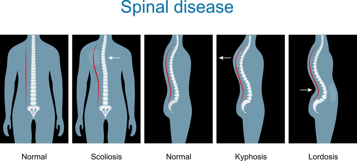 Lordosis vs Kyphosis vs Scoliosis: Comparing Different Types of Spinal Curvatures