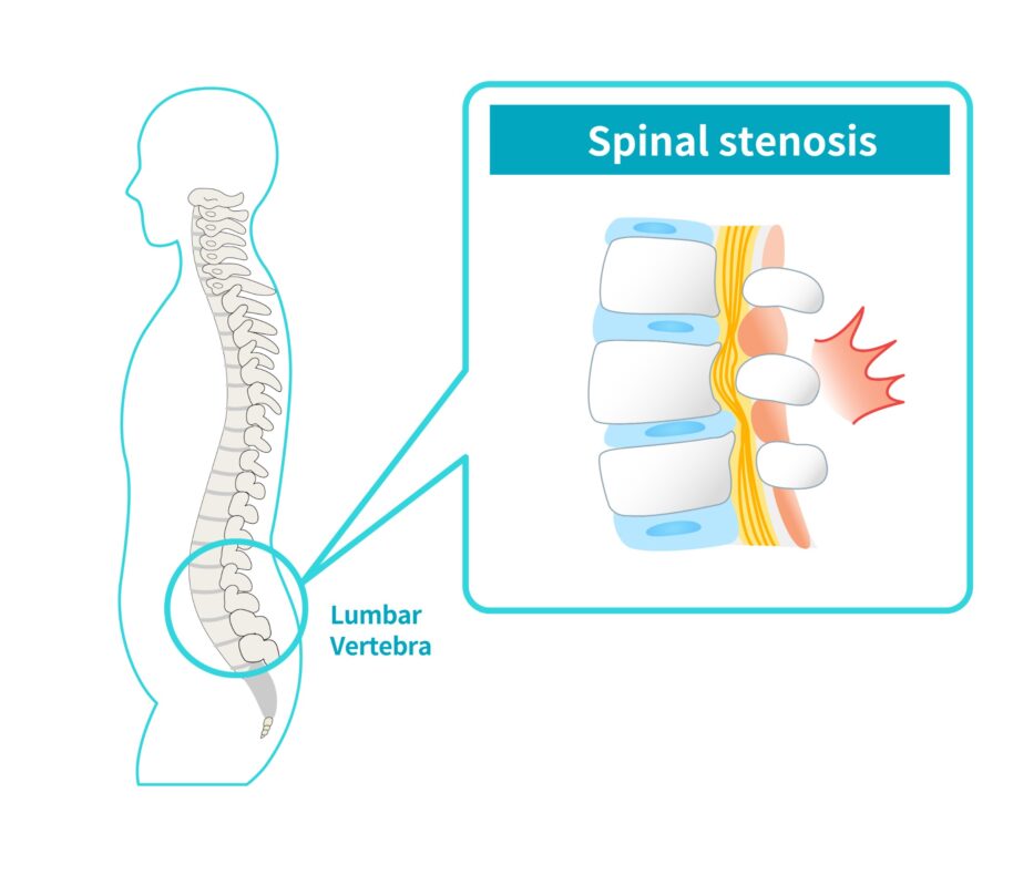 Scoliosis and Spinal Stenosis Combination