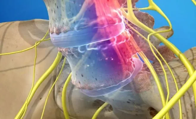 Skoliose und Spondylolisthesis verstehen: Ursachen, Symptome und effektives Management