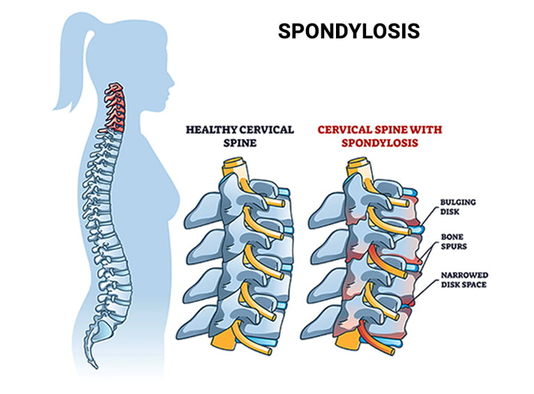 Spondylosis and Scoliosis