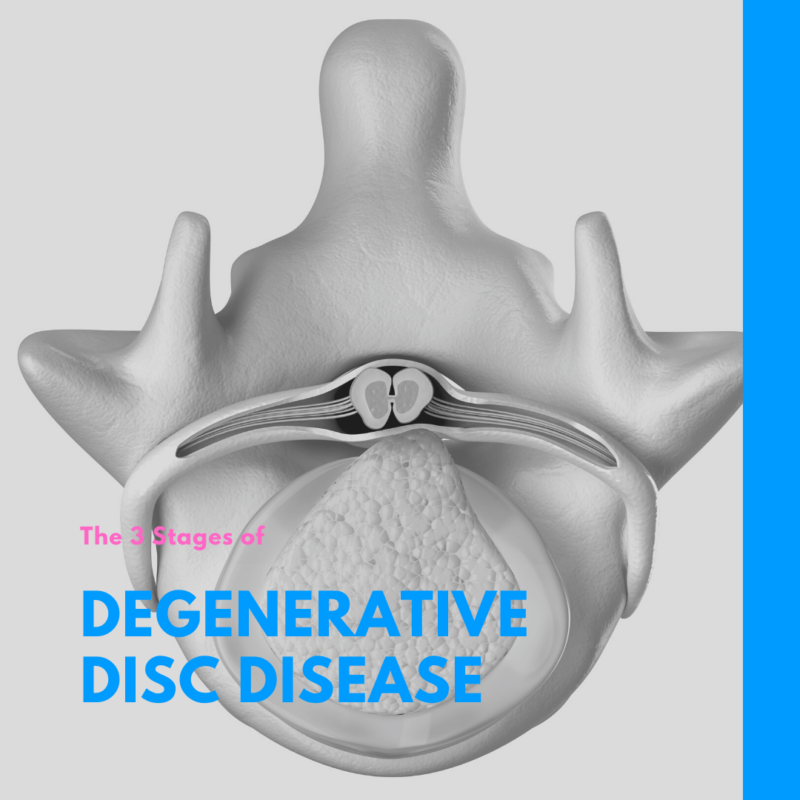 Degenerative Disc Disease Cause Scoliosis