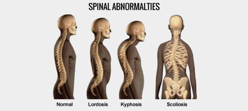 Lordose vs Cifose vs Escoliose: Comparação dos diferentes tipos de curvaturas da coluna vertebral