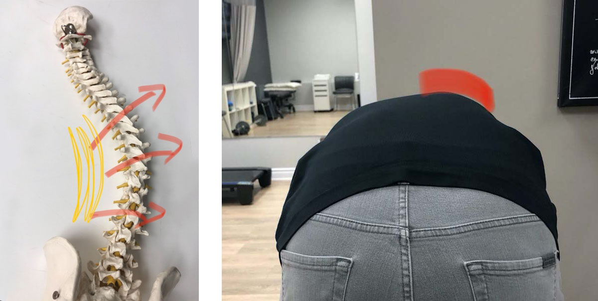 Test de flexion avant en cas de scoliose