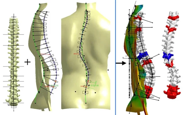 Enfoques Innovadores para Corregir la Escoliosis: Técnicas avanzadas para una corrección eficaz de la columna vertebral