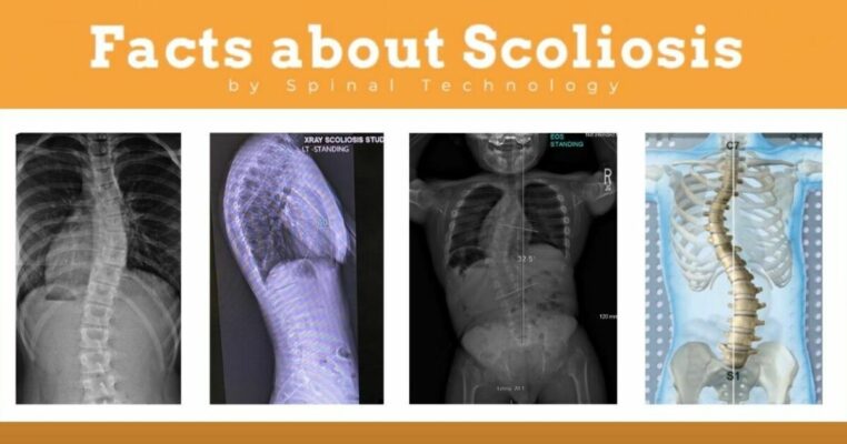 Die interessantesten Fakten über Skoliose: Einzigartige Aspekte der Wirbelsäulengesundheit, die Sie kennen sollten