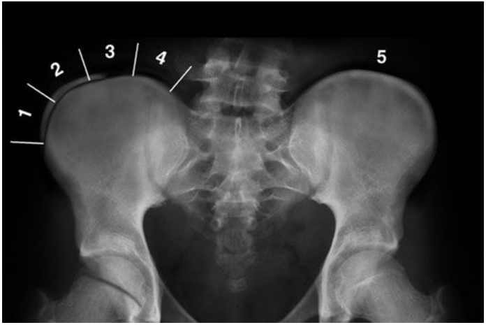 La Escala de Risser para la Escoliosis: Evaluación del crecimiento de la columna vertebral, la madurez y el riesgo de progresión de la curva