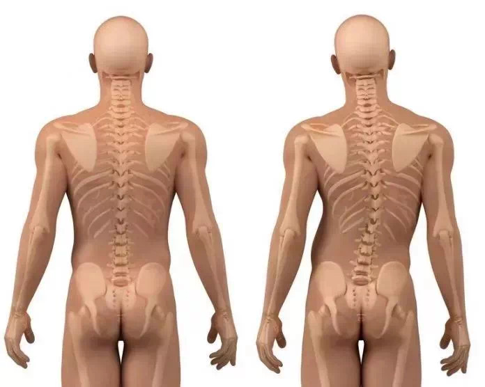 Thoracic Scoliosis: Symptoms, Causes, Treatment Options