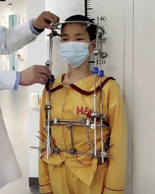 Does Scoliosis Stop Growth? Understanding Scoliosis' Impact on Growth Patterns and Development in Children