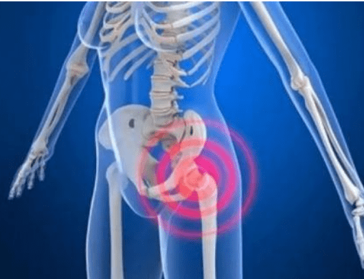Understanding How Scoliosis Can Impact Hip Development and Alignment: Scoliosis Hip Dysplasia Insight