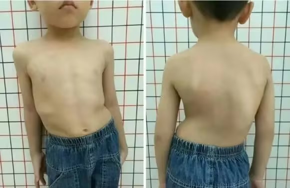 Examining the Genetic Factors and Family History Connections Related to Scoliosis