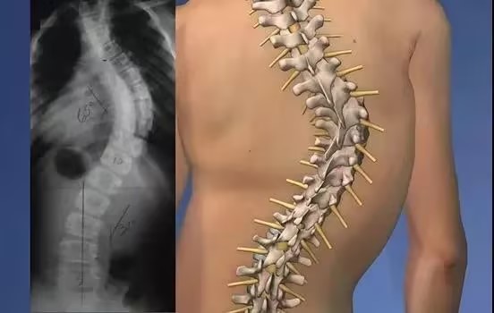 Scoliosis X Ray Pics: How Imaging Reveals Spinal Deformities