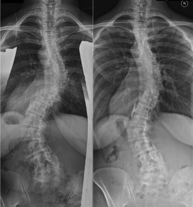 para interpretar uma radiografia de escoliose menor: Reconhecendo os primeiros sinais de deformidade da coluna vertebral