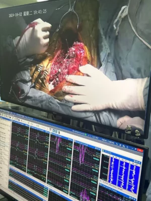 Efeitos a longo prazo da fusão espinal para a escoliose