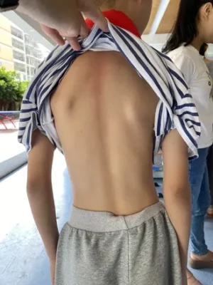 Infografik zur Skolioseprogression: Analyse, ob sich die Skoliose nach dem Wachstumsstopp verschlimmern kann, und Faktoren, die ihre Veränderungen beeinflussen.