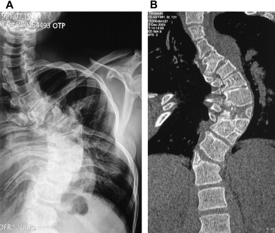 Interprétation de la scoliose par la radiologie