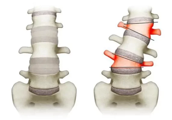 Skoliose auf Spanisch verstehen