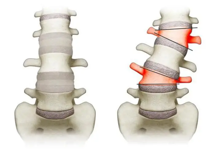 Understanding Scoliosis in Spanish