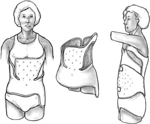 Scoliosis Boston Brace