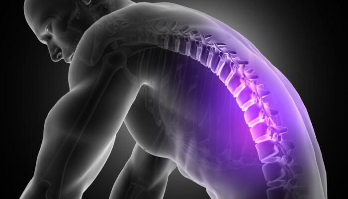Scoliosis Functional : How Spinal Curvature Affects Functional Abilities and Daily Life