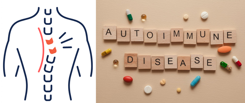 Scoliosis Autoimmune Disease