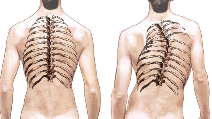 Uneven Rib Cage Scoliosis