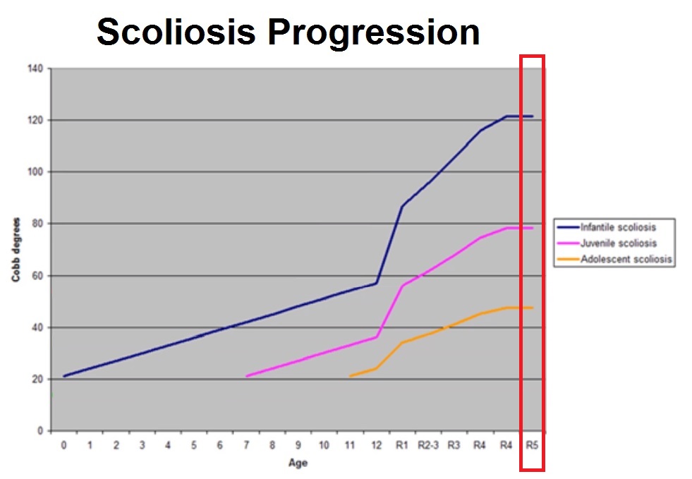Can Scoliosis Get Worse in Your 20s