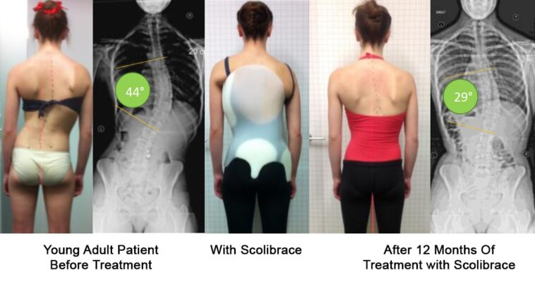 Antes y después del corsé para escoliosis: Cambios visuales y funcionales observados en el tratamiento con corsé para escoliosis