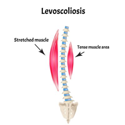 Levoscoliosis vs Scoliosis