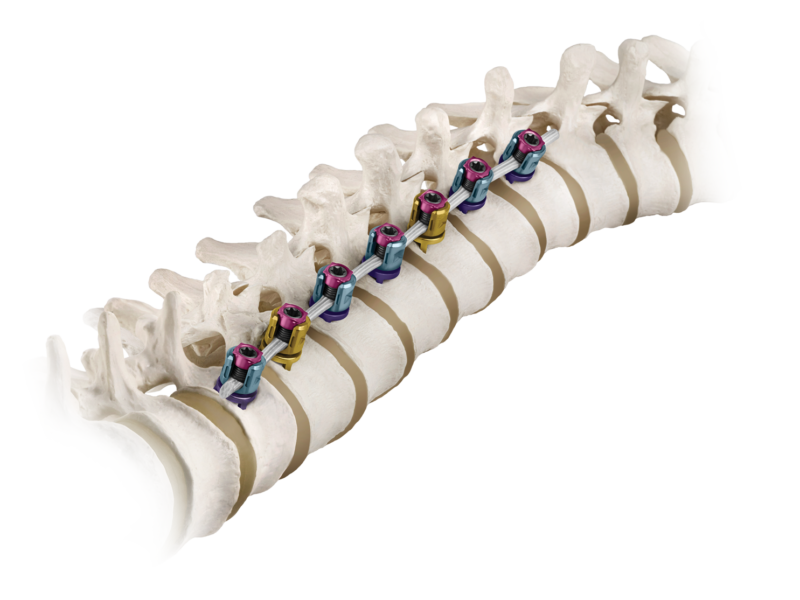 Tethering Scoliosis