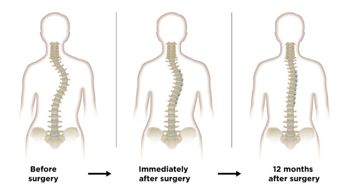 Graus de gravidade da escoliose: Compreender a classificação e o tratamento