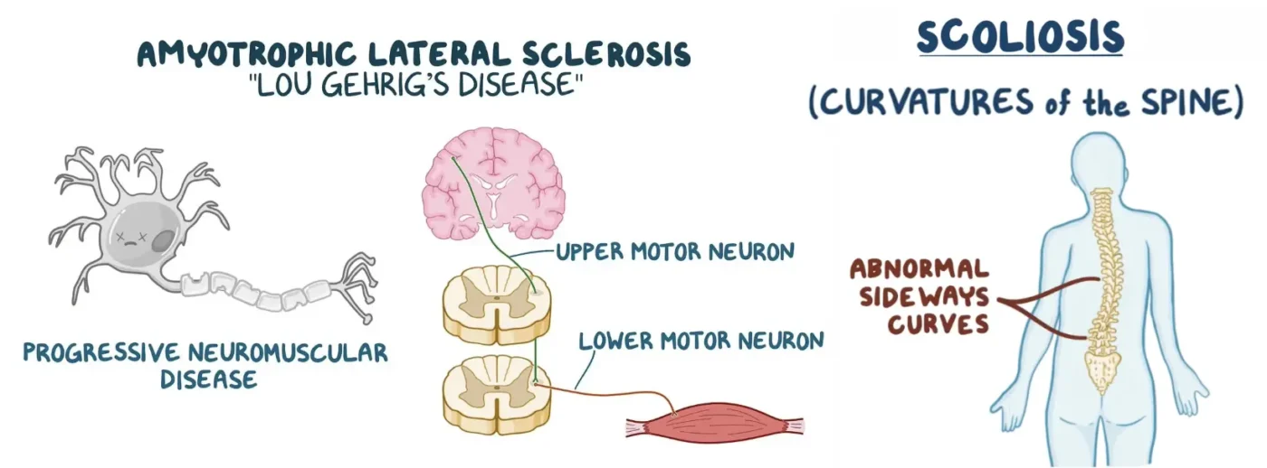 Scoliosis vs Multiple Sclerosis