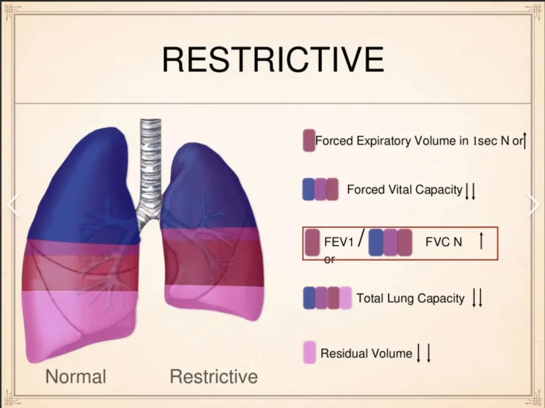 Restrictive Lung Disease Scoliosis