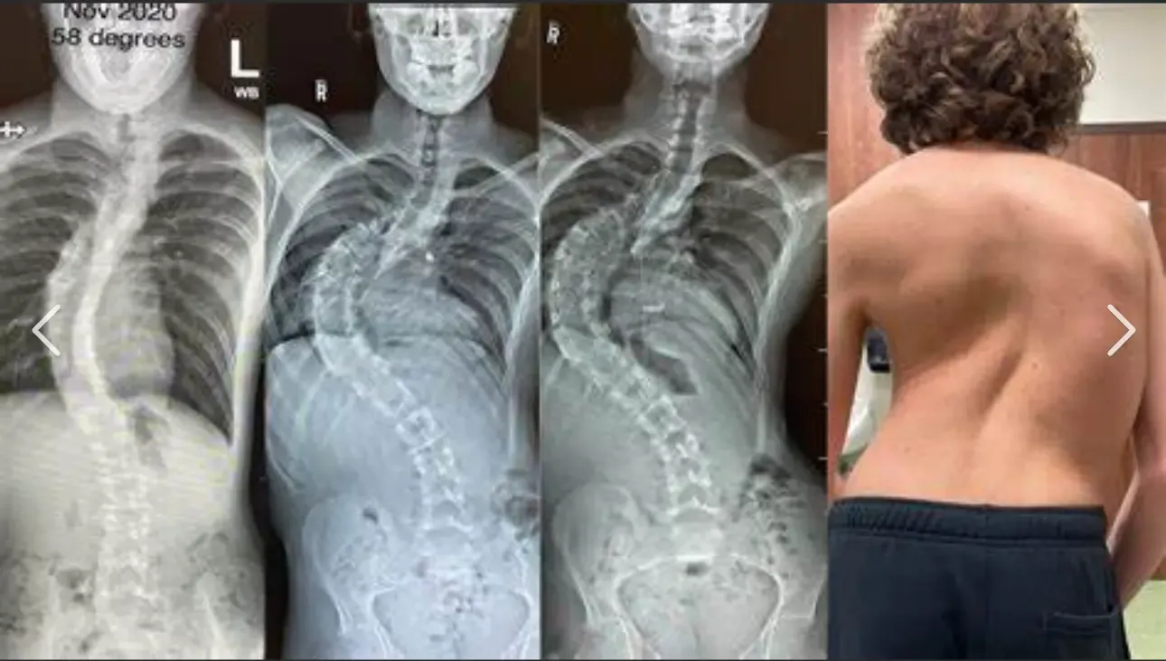 Raio X da escoliose grave: Qual o aspeto da escoliose grave nos raios X e o seu impacto no planeamento do tratamento