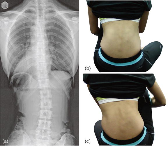 ICD 10 Code for Thoracolumbar Scoliosis
