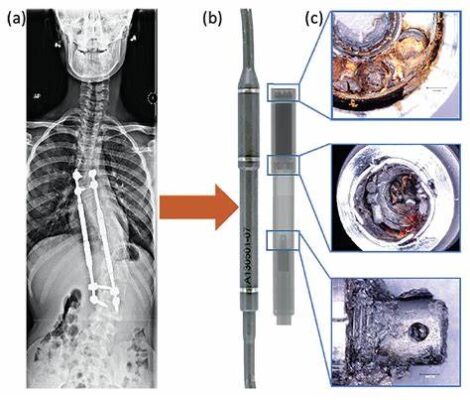 Varillas Cirugía de la escoliosis