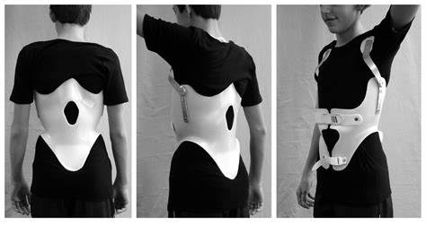 TLSO Scoliosis Brace: Choosing and Using a TLSO Brace for Optimal Scoliosis Support and Correction
