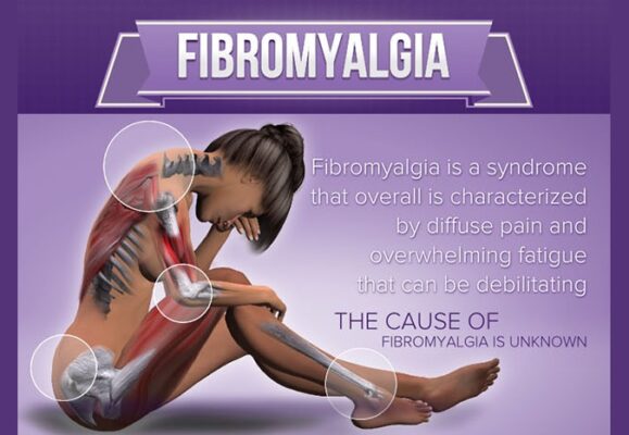 Fibromyalgie et scoliose : Explorer le lien entre la fibromyalgie et la scoliose et les stratégies de prise en charge efficaces