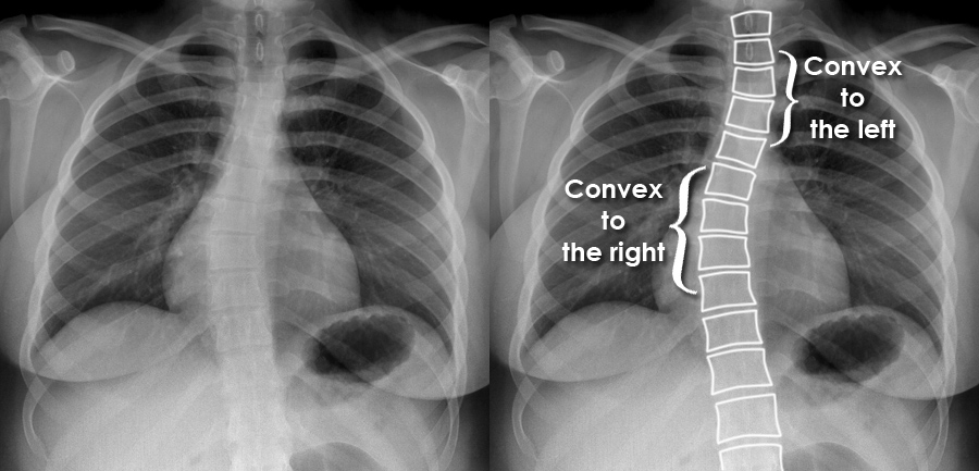 Patient Education for Scoliosis: Empowering Patients with Knowledge for Better Health Outcomes