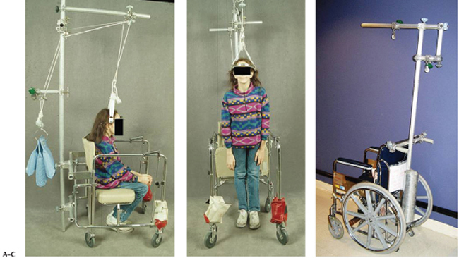 Halo Scoliosis: A Detailed Look at the Use of Halo Traction for Scoliosis Treatment and Its Outcomes