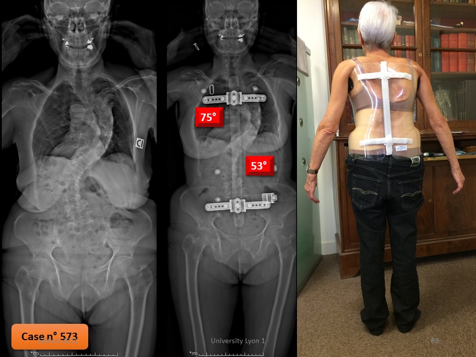 Skoliose bei Erwachsenen über 70: Verständnis der Auswirkungen und Behandlungsmöglichkeiten für altersbedingte Skoliose