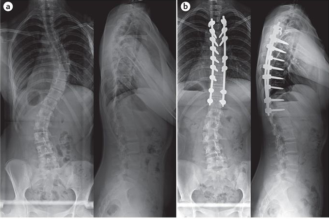 Moderate Scoliosis X-Ray: Interpreting X-Ray Results for Moderate Scoliosis and Understanding Its Implications