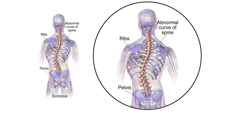 La scoliose peut-elle affecter les reins ?