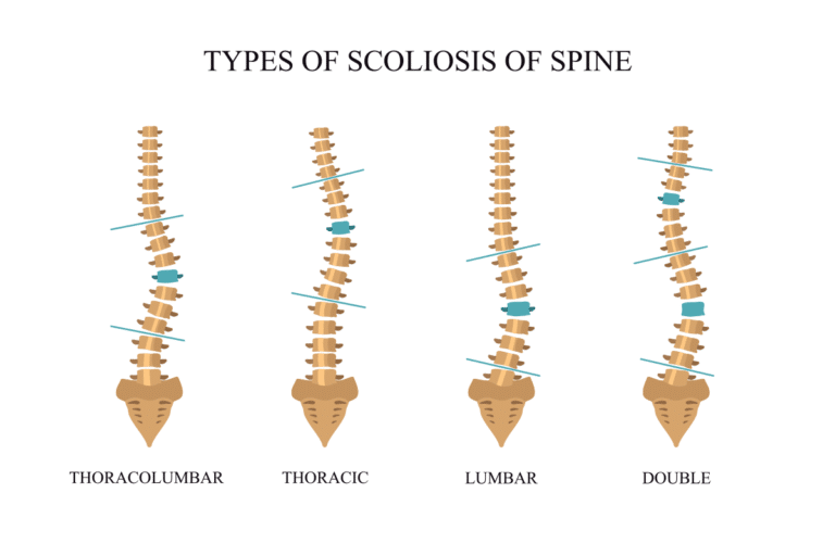 Types of Structural Scoliosis