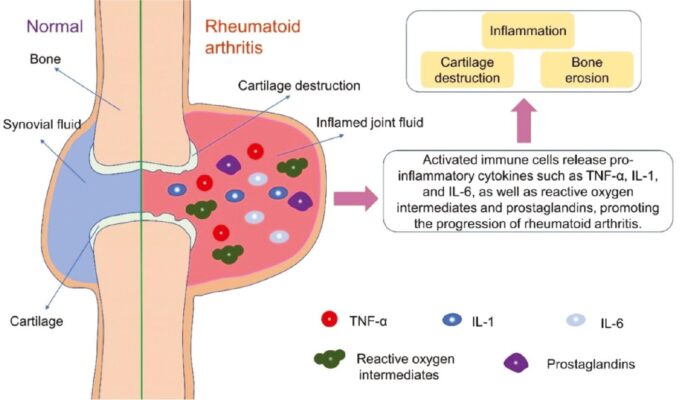 Scoliosis and Rheumatoid Arthritis