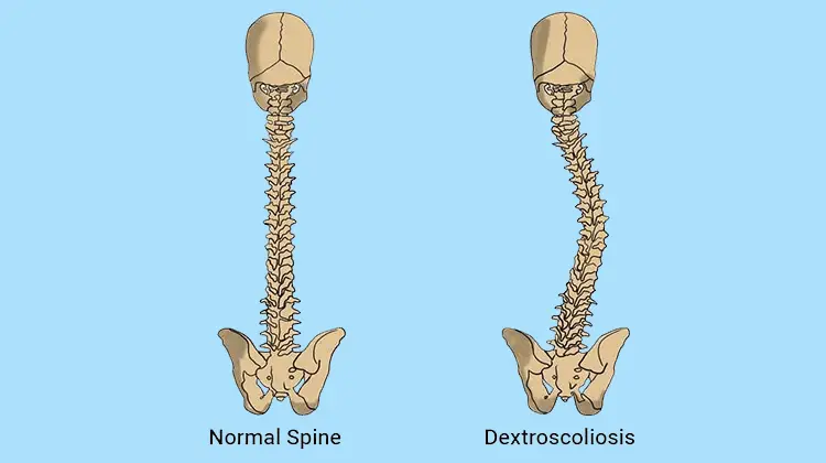 Dextroconvex Scoliosis of the Thoracic Spine: A Comprehensive Guide to Treating and Managing Dextroconvex Scoliosis in the Thoracic Region