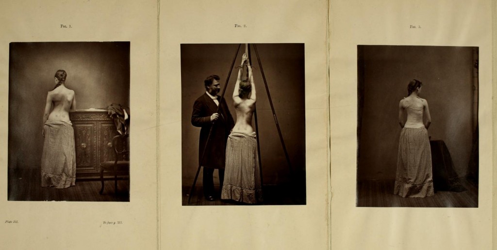 Escoliose de Lewis Sayre