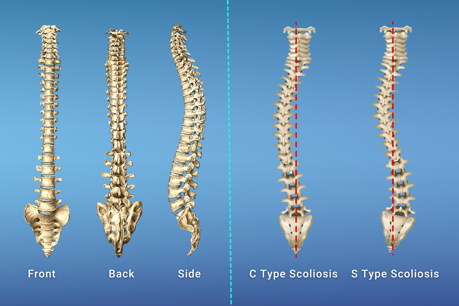 Scoliosis Pregnancy Complications
