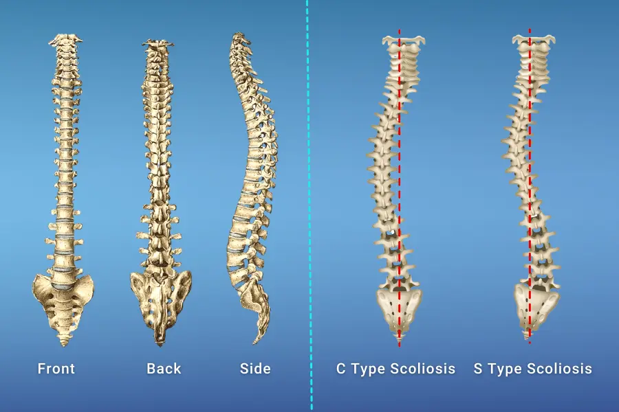 Worst Case of Scoliosis