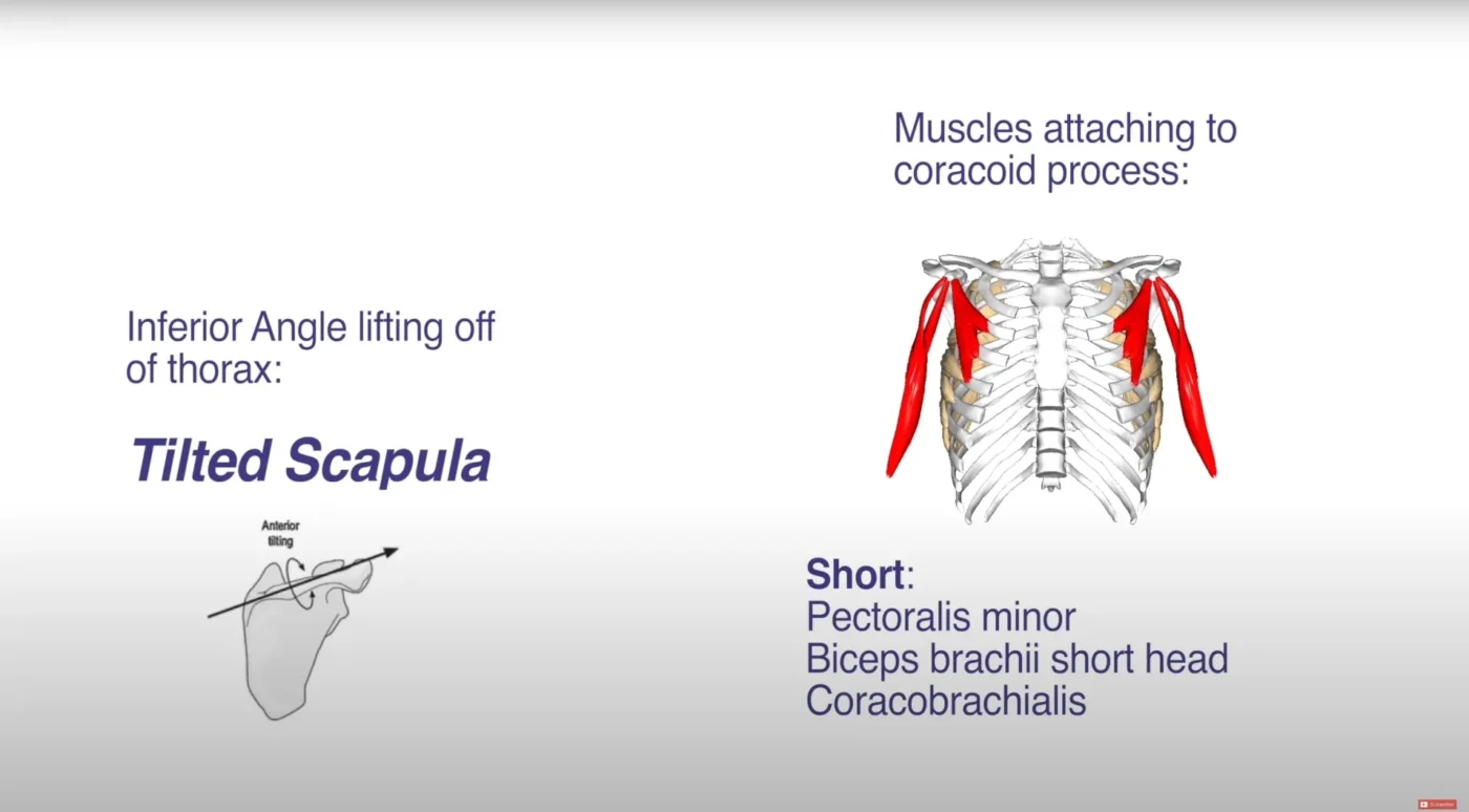 Winged Scapula Scoliosis
