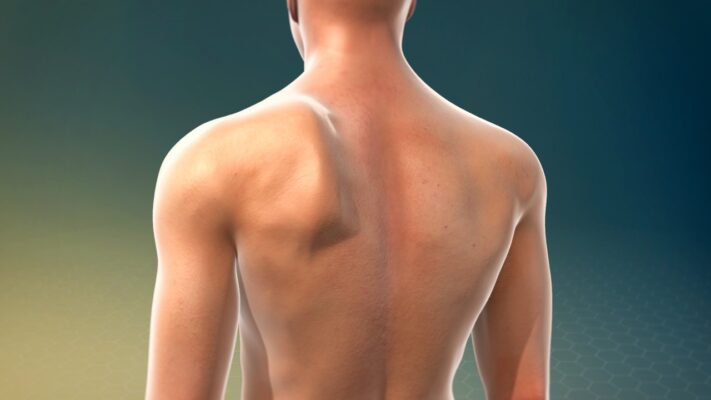 Winged Scapula Scoliosis
